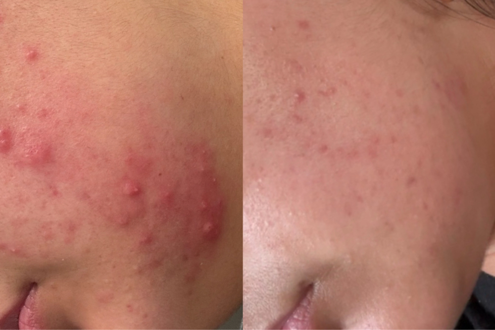 ⭐️Clear Skin Kickstart $327-$247 at Omnific Beauty By Nelly in Selma, CA