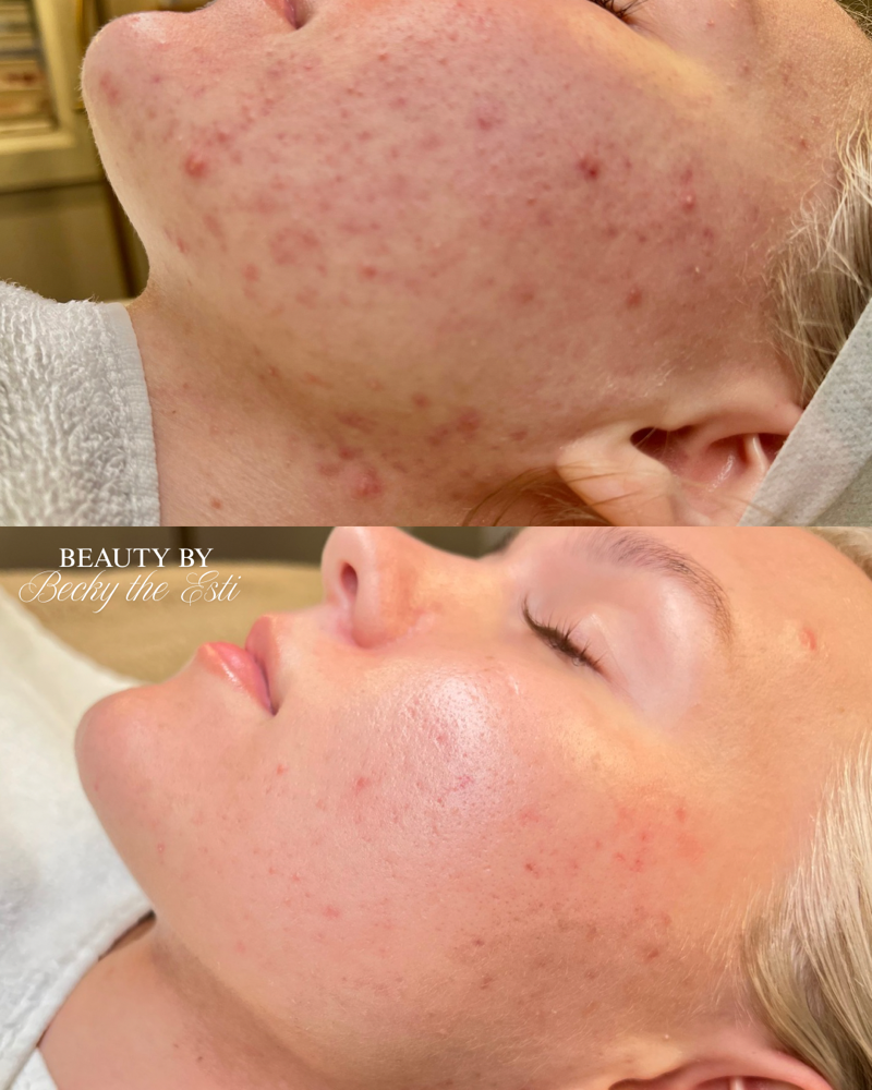 Acne Bootcamp Consultation