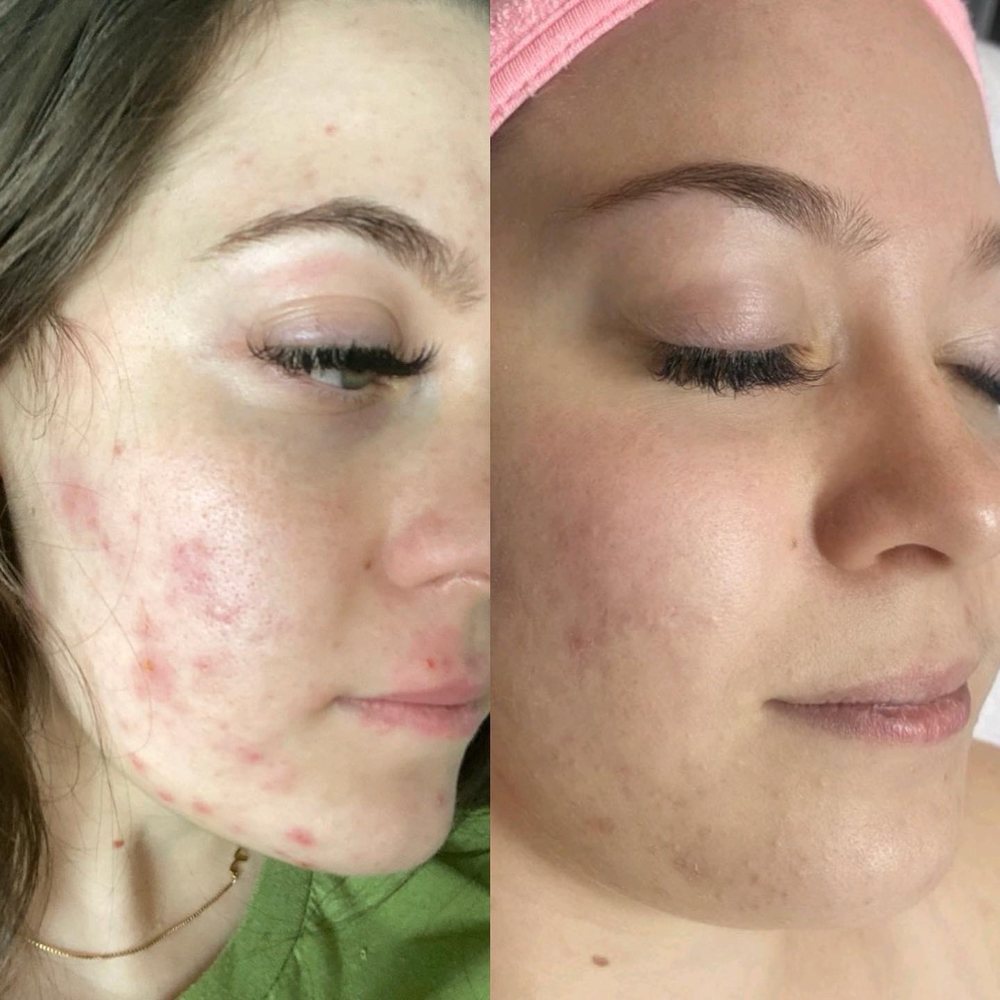 Acne Bootcamp Consultation