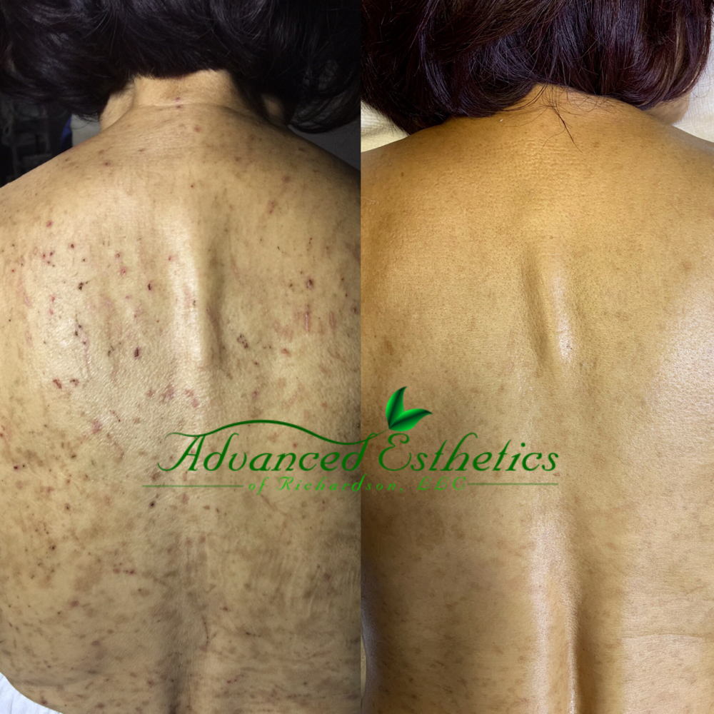 Chemical Peel For Back