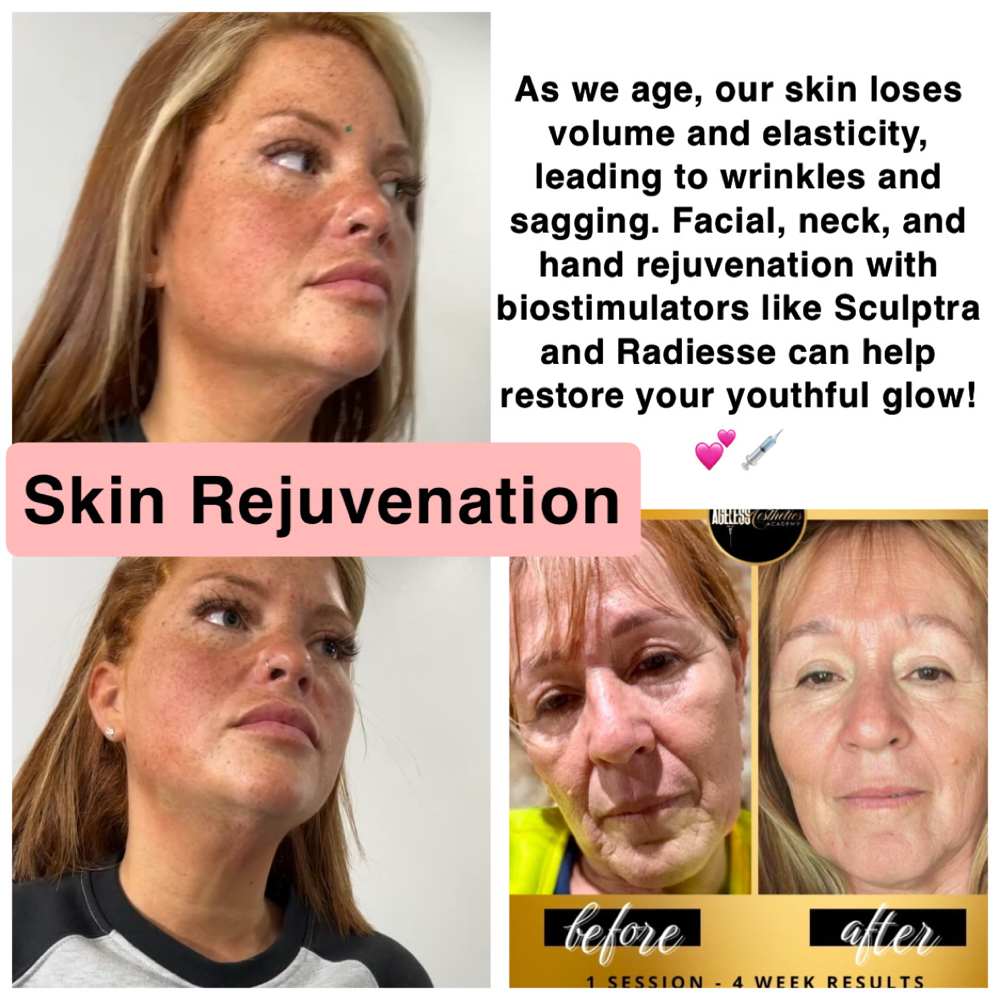 Hand Rejuvenation