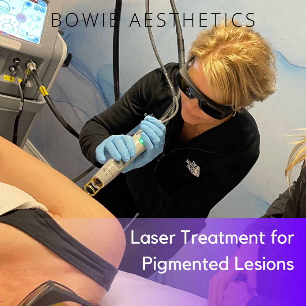 Laser Treatment For Pigmentation