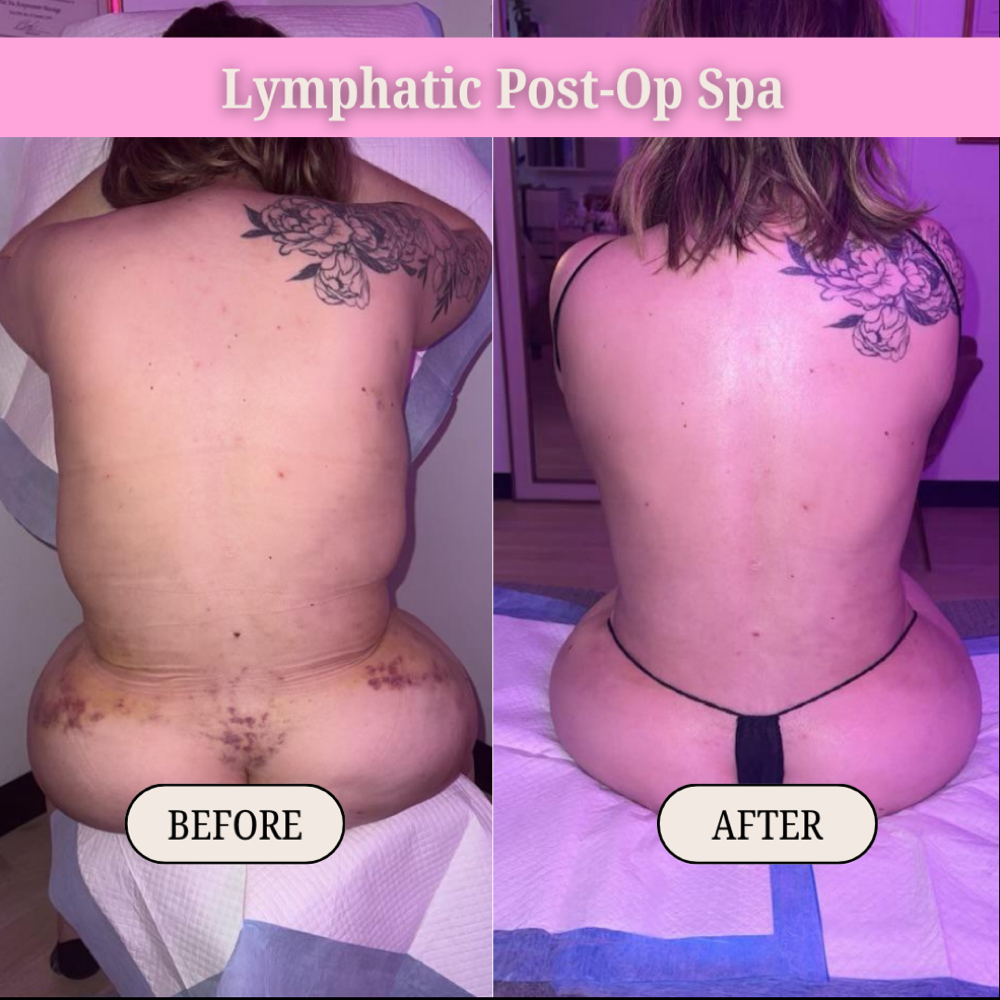 Post-Op Lymphatic Drainage Massage at Lymphatic Post-Op Spa in San Diego, CA