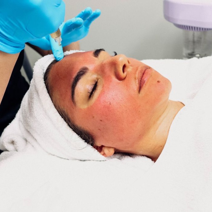 Plasma Rico en Plaquetas (PRP) at Lumiee Skincare Llc in Chicago, IL