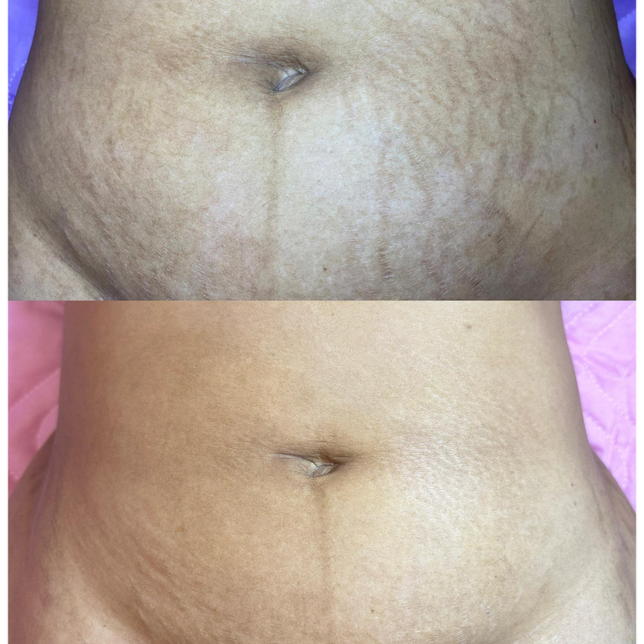 INKLESS STRETCH MARK REVISION at PMU ink and beauty in Monterey, CA