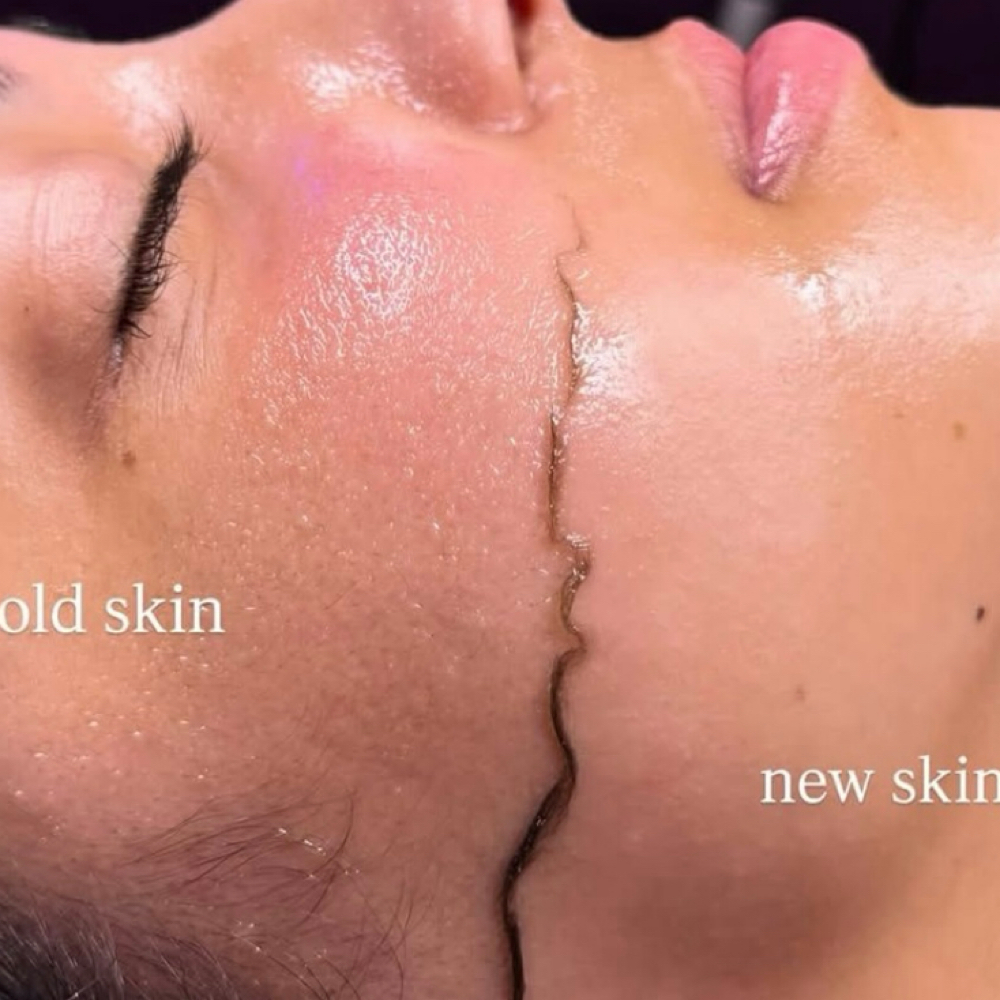 Dermaplane GLOW Facial at Garden of Grace Co. in Van Alstyne, TX
