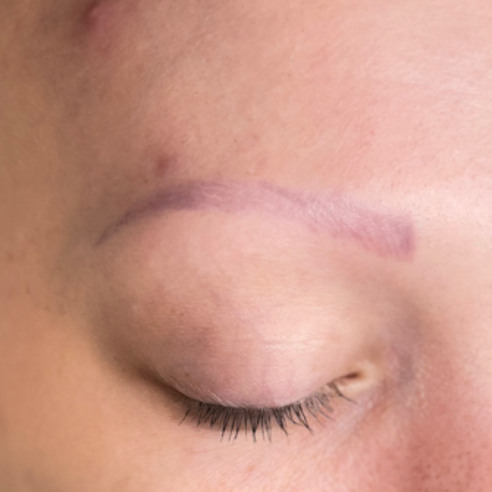 PMU Removal Saline/Glycolic at Aurora Aesthetics 888 in Olean, NY