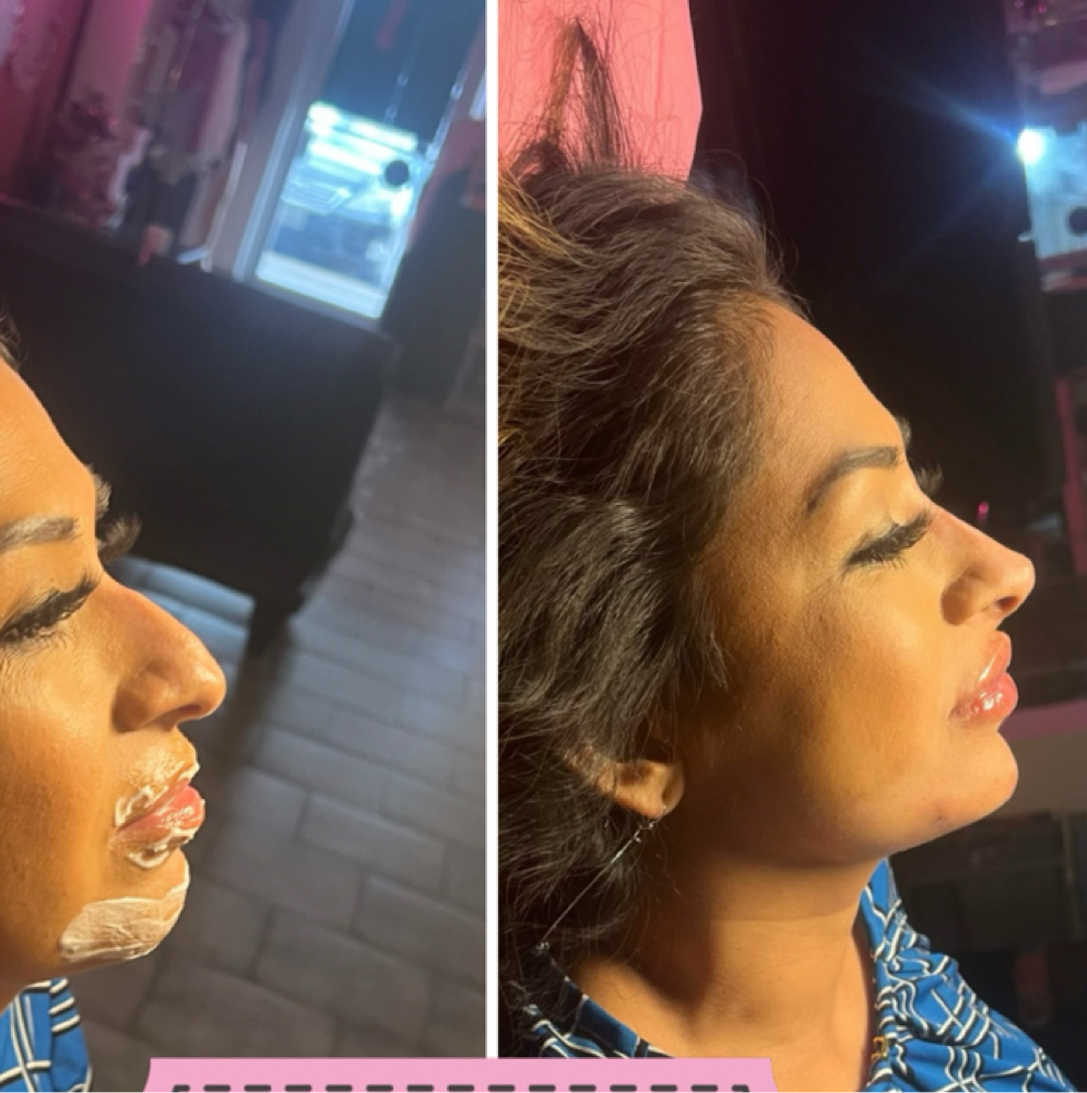 🔹 CHIN FILLER at Flawless Spa & Beauty in Fort Worth, TX