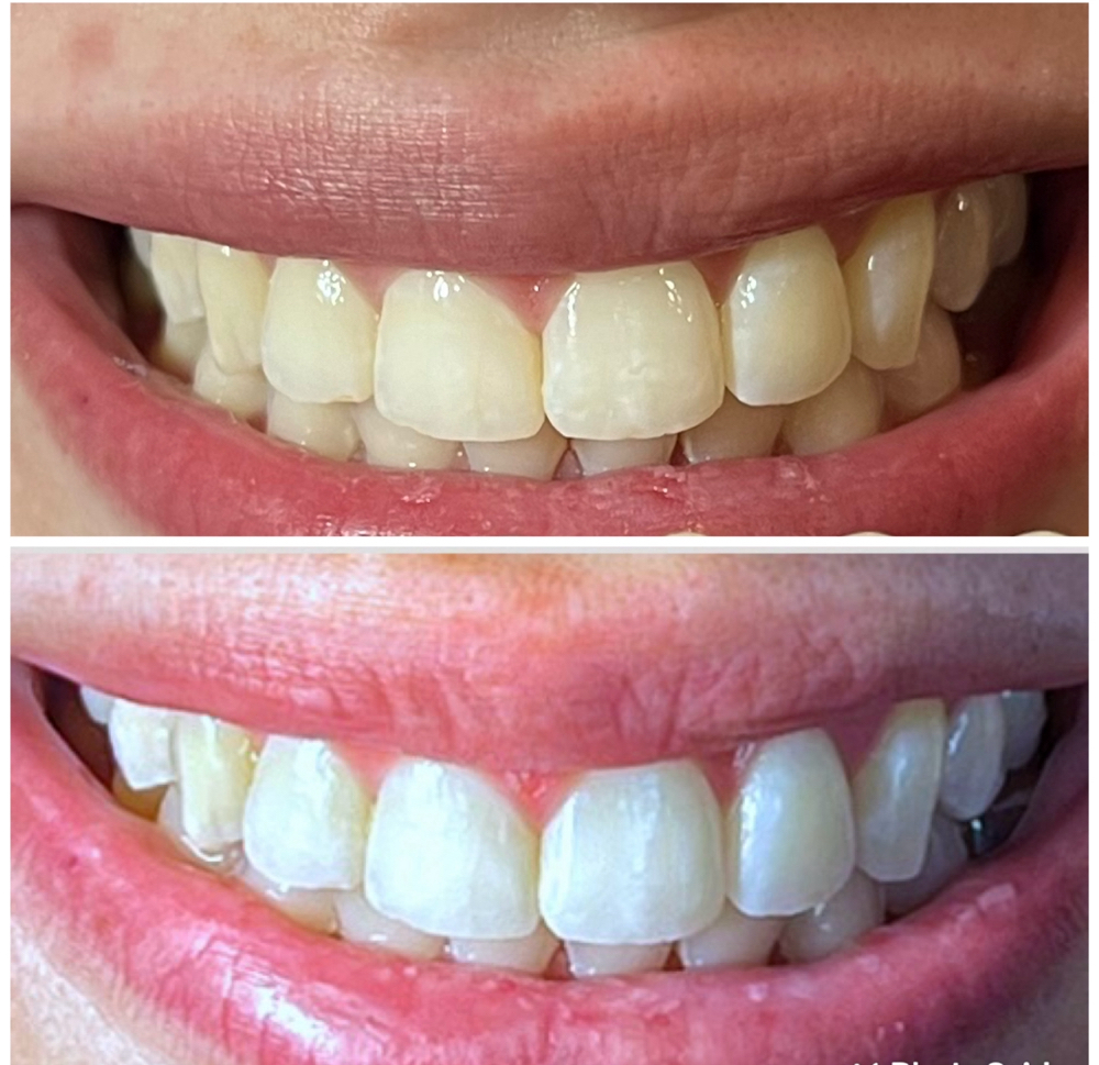 Teeth Whitening 30 Min Touch Up