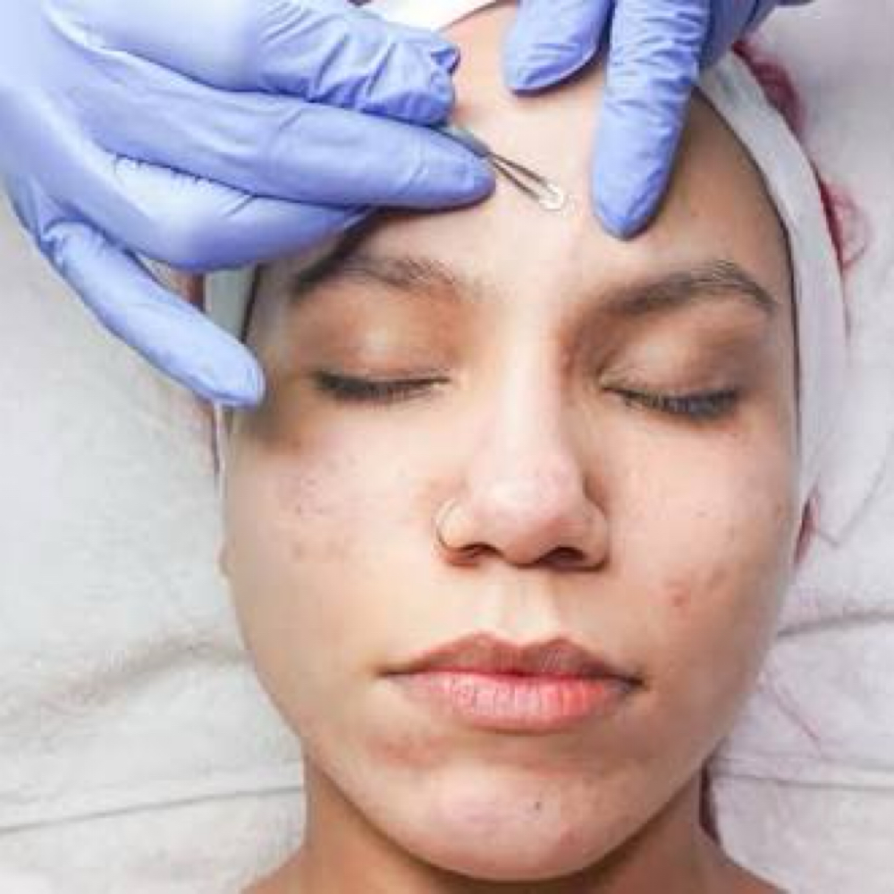 Acne Clarifying Facial at Radiant Touch Esthetics in Mishiwaka, IN