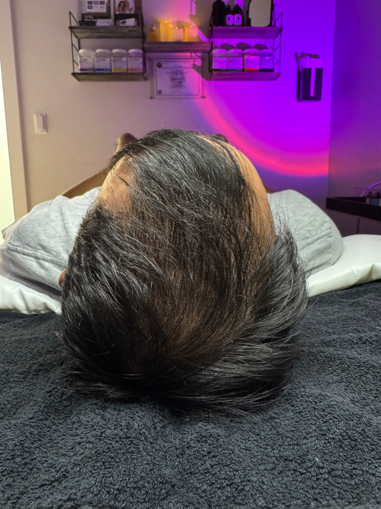 MesoJet Hair Restoration Treatment