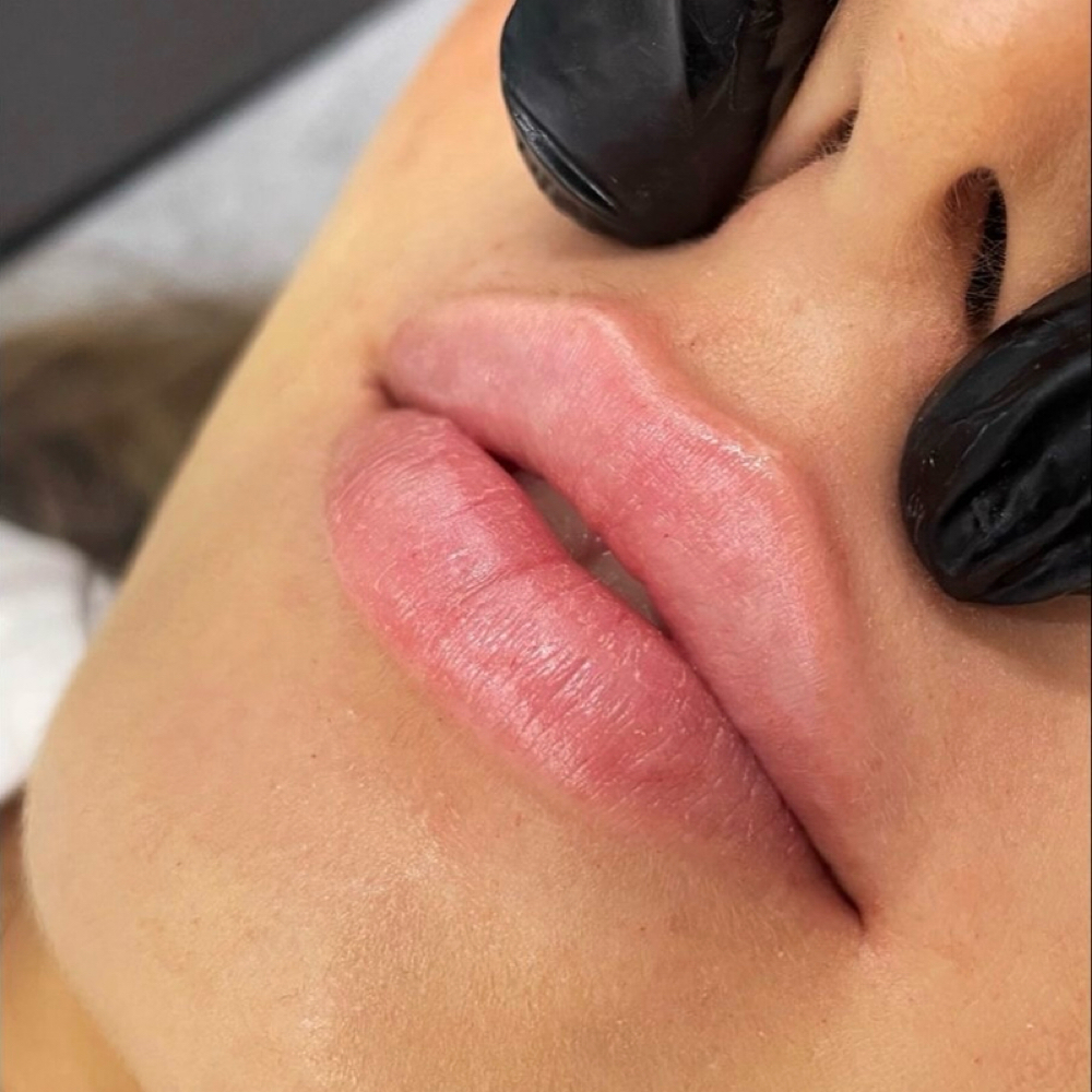 Hylauronic Acid Lip Filler at Fringe & Co. Salon in Alexander City, AL