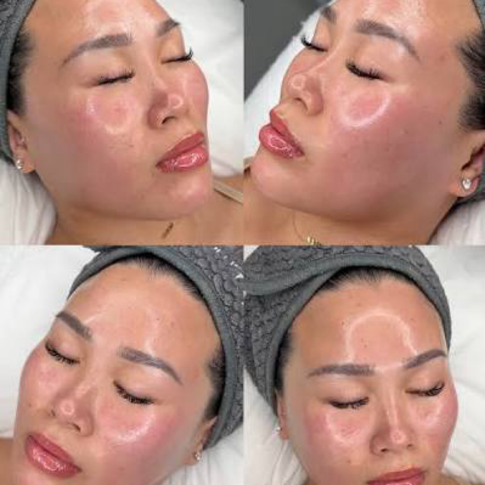 Signature Glass Skin Facial at Elite Esthetic Lounge in Manalapan, NJ