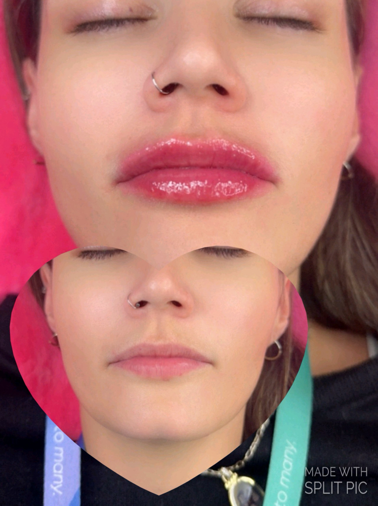 Lip Augmentation 1/2 💉