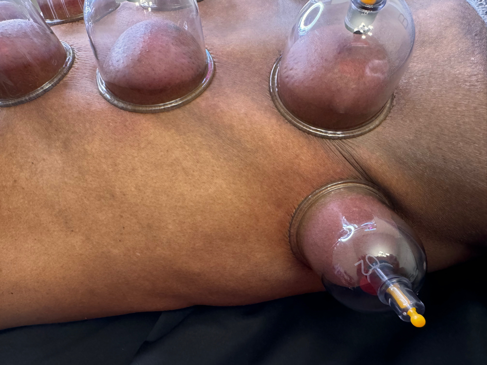 Cupping Therapy