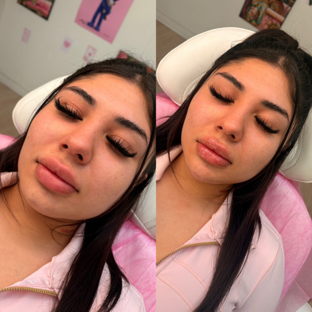 Chin Filler at Balance.Bar.Aesthetics in Berkeley, CA