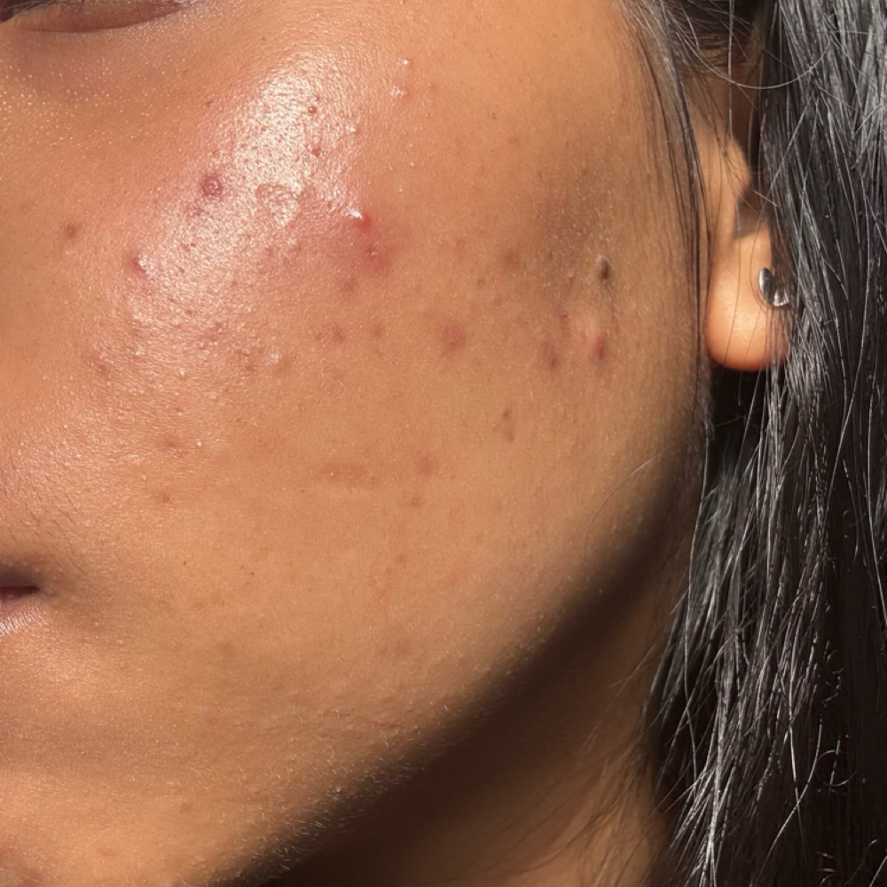 Acne Edition Facial at Nather Skin in Hoboken, NJ