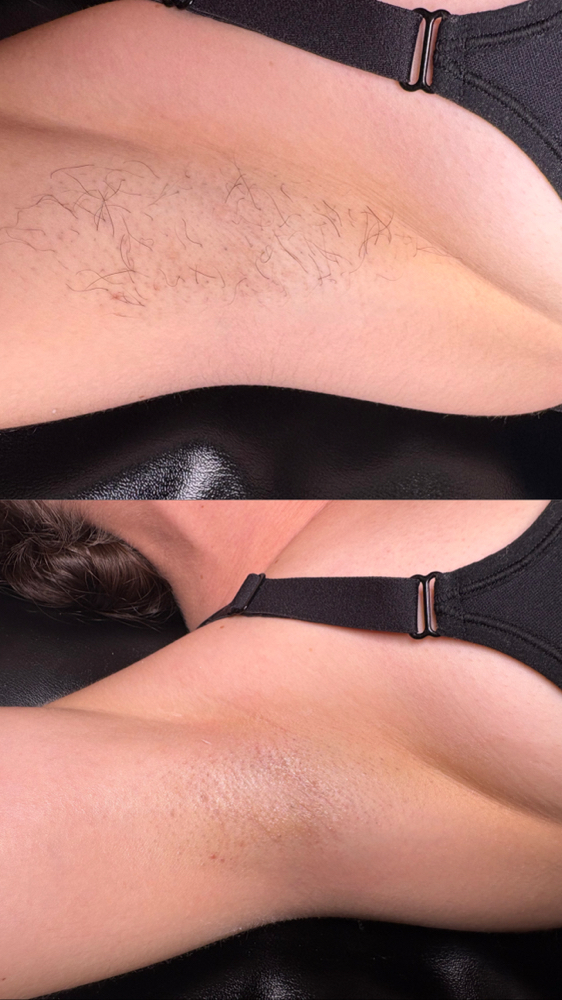 Underarm