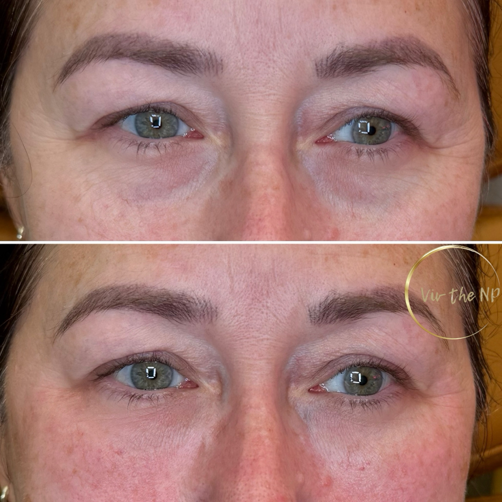 Plasma Under Eye Treament
