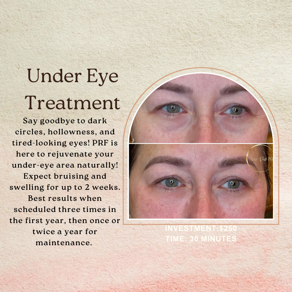 Under Eye Treament