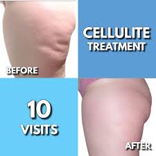 Body- Neveskin  Body 10 Pack