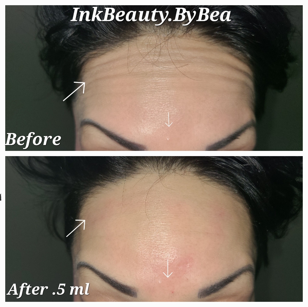 Face Fillers  1area 1session