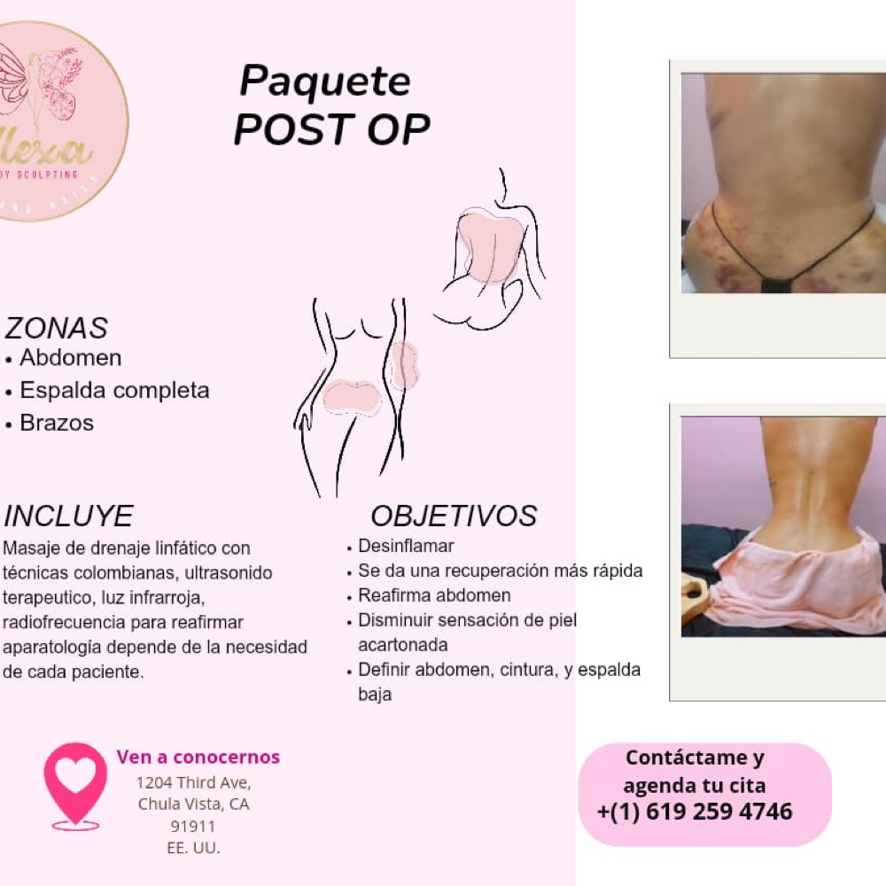 Post Operatorio – Drenaje Linfático at Alexa spa body sculpting in Chula Vista, CA