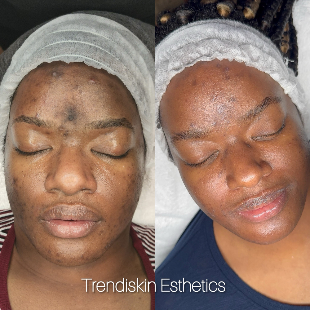 Spot Correcting Peels (2 Weeks)