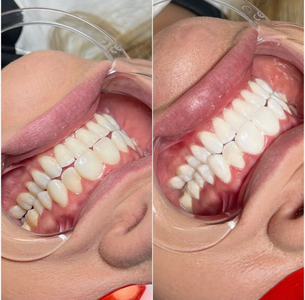 Teeth Whitening