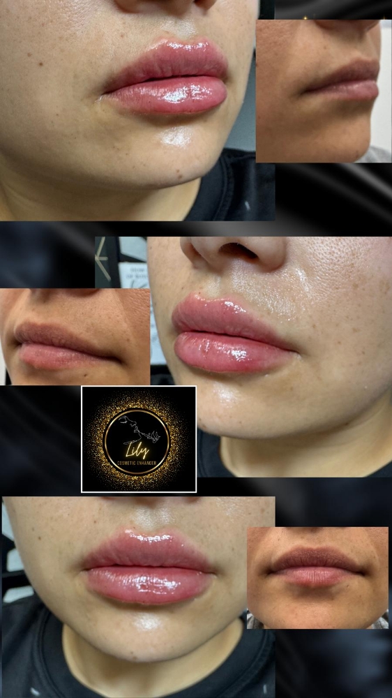 Restylane Kysse