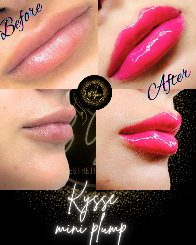 Restylane Kysse