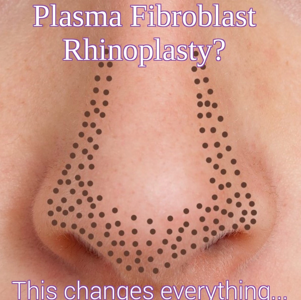 Fibroblast Nose Contour at Faces by DeAngela in New Brockton, AL