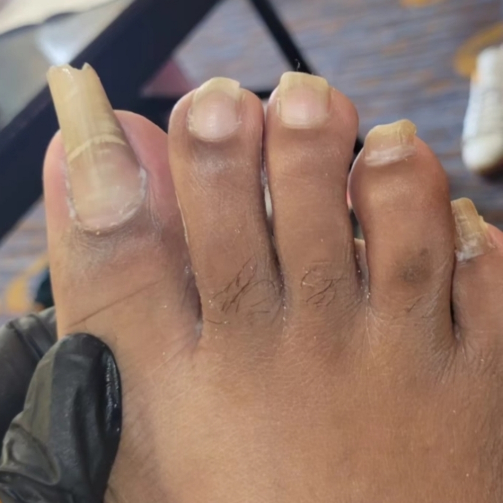 Toenail Cutting & Debridement