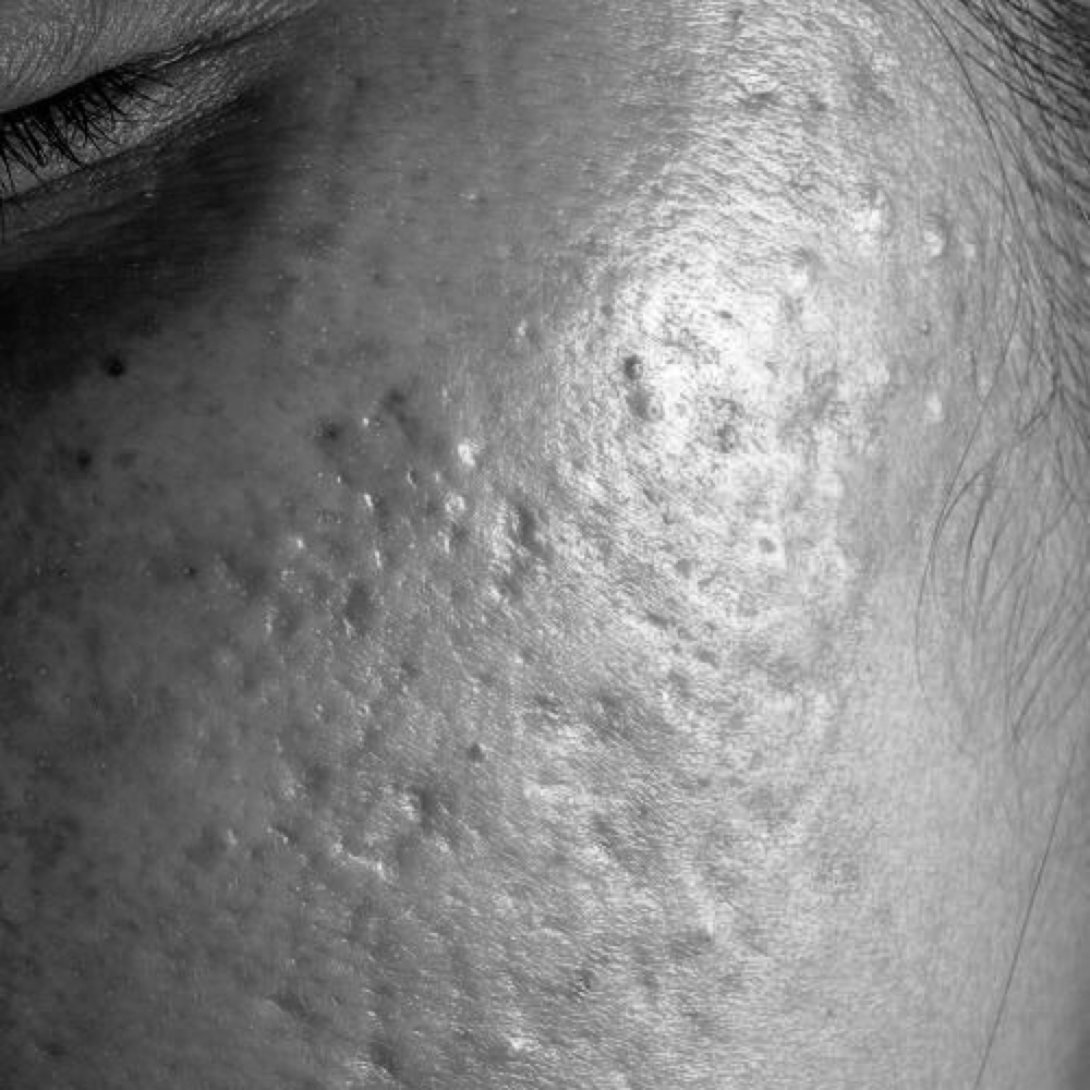 The Clear Reset 2.0 at Good Skin in Dublin, OH