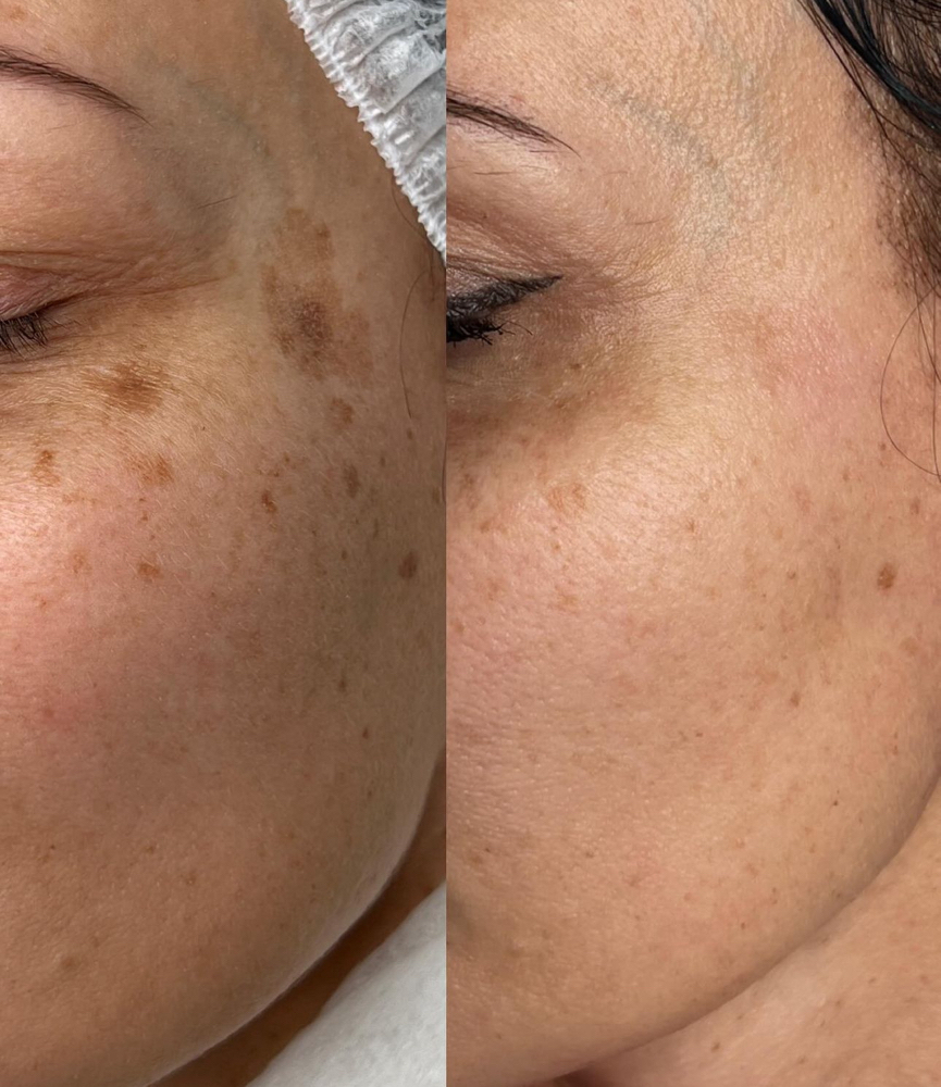 pigmentation removal