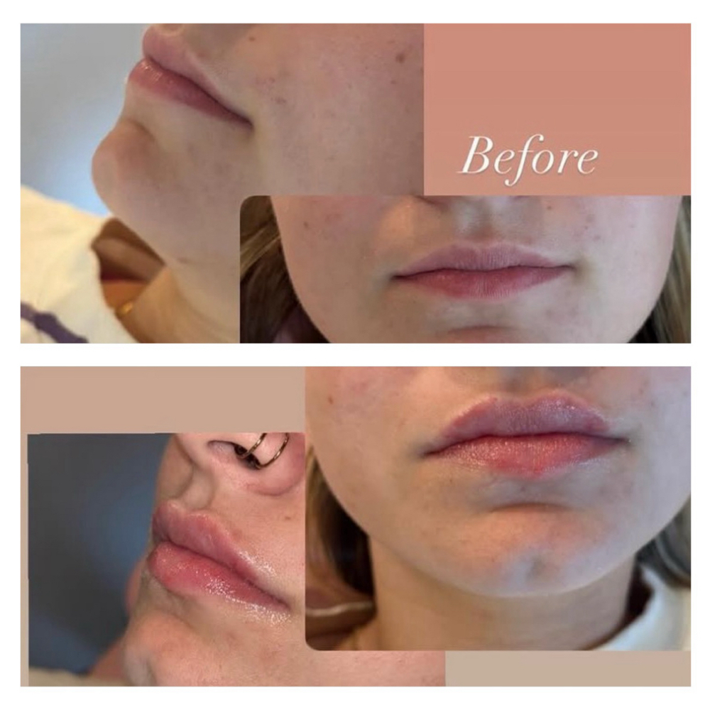 Full Syringe Filler at Magnolia Wellness and Aesthetics