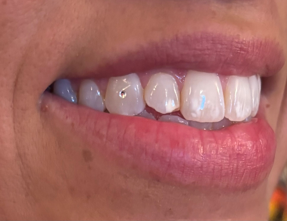 Tooth Gem Application- Dainty