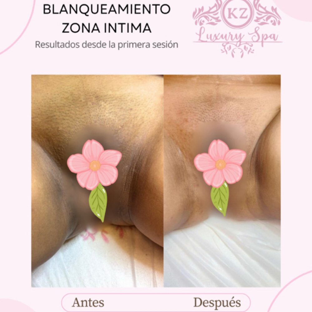 Blanqueamiento at Kz Luxury Spa in Houston, TX