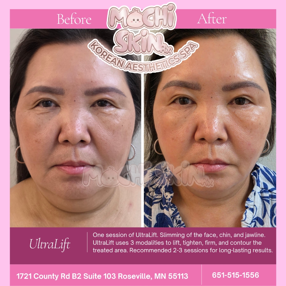 UltraLift (NECK ONLY- JULY PROMO) at Mochi Skin Rx in Roseville, MN
