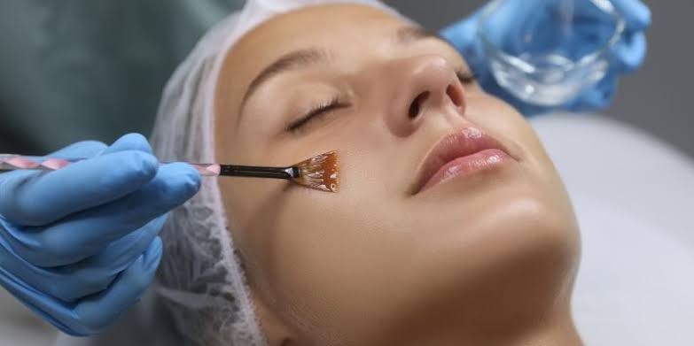Customized Chemical Peel