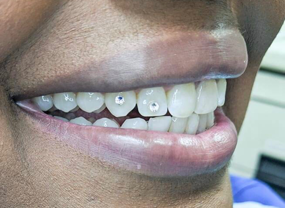 Teeth Whitening/Tooth Gems (2 Gems)