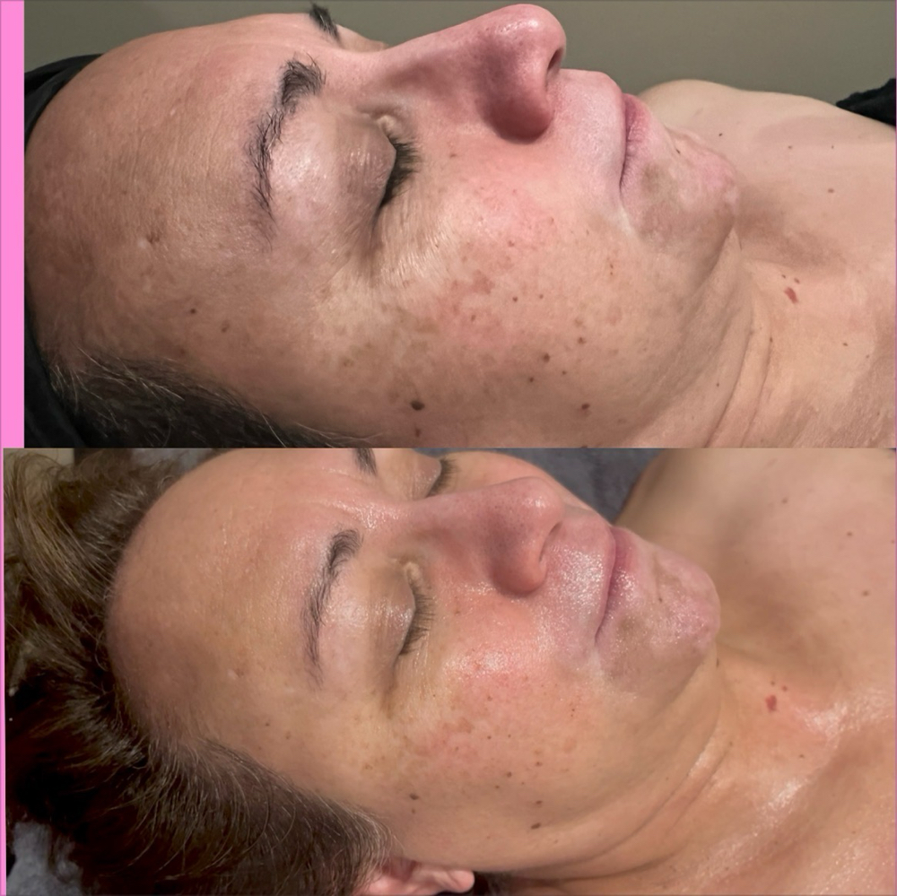 Salmon PDRN Facial