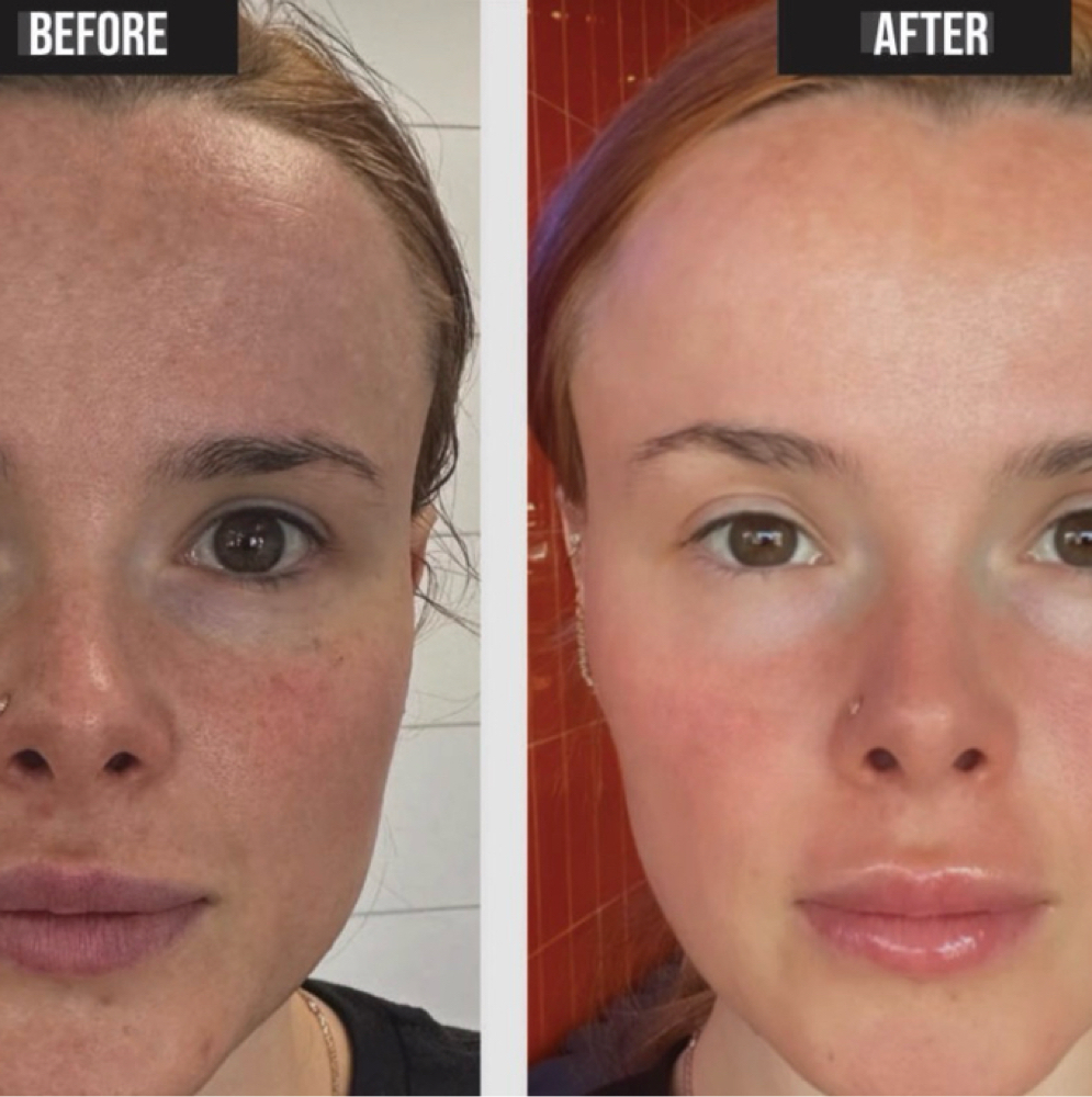Plasma Skin Tightening at Finesse Studio in Grand Junction, CO