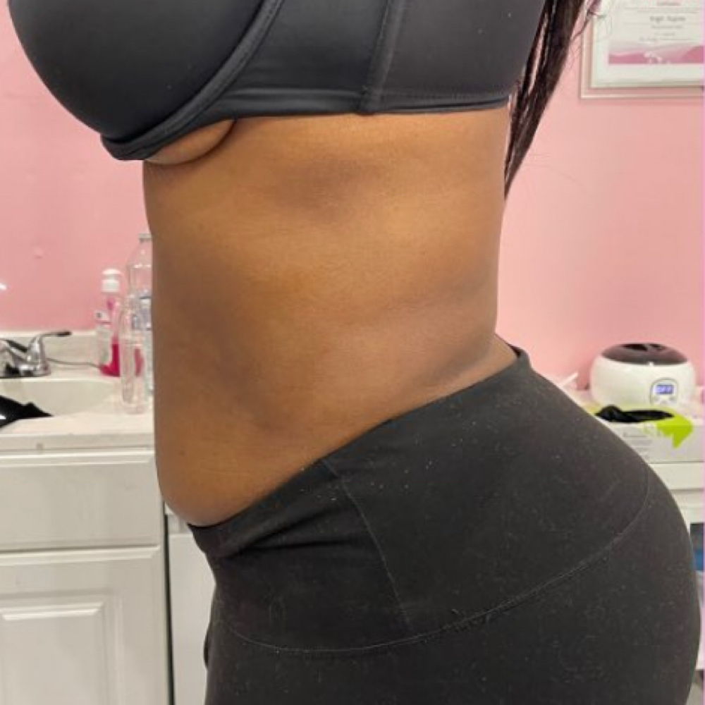 TOTAL TUMMY TRANSFORMATION at Esthiology Skin Lab in Nottingham, MD
