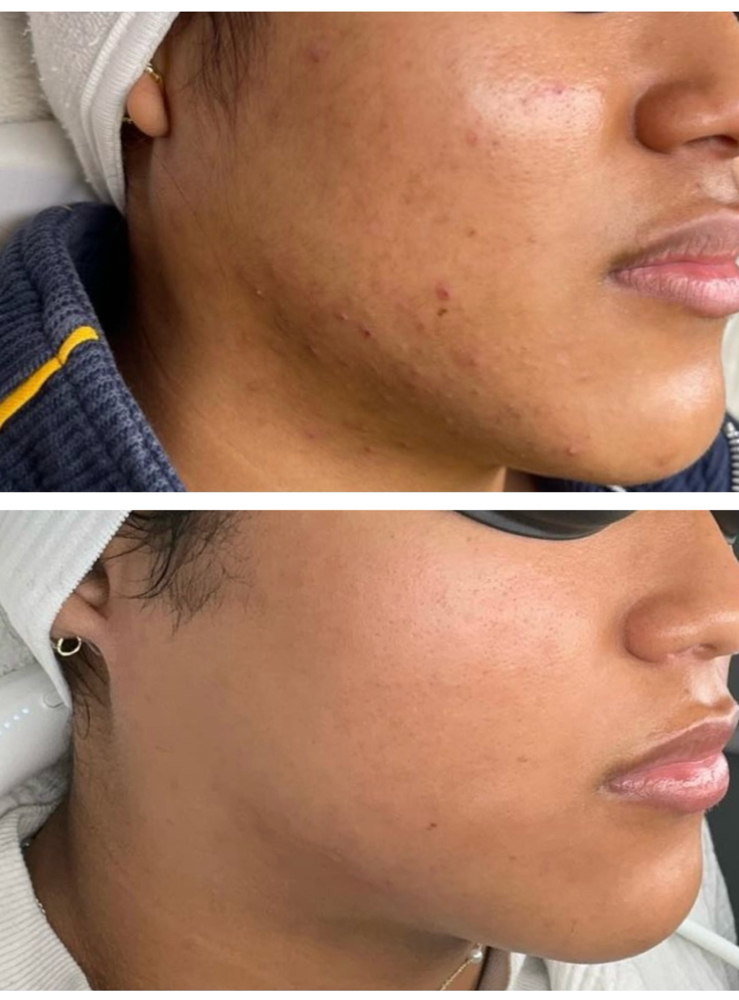 Acne Correction Program at Serene.Esthetics in Franklin Square, NY