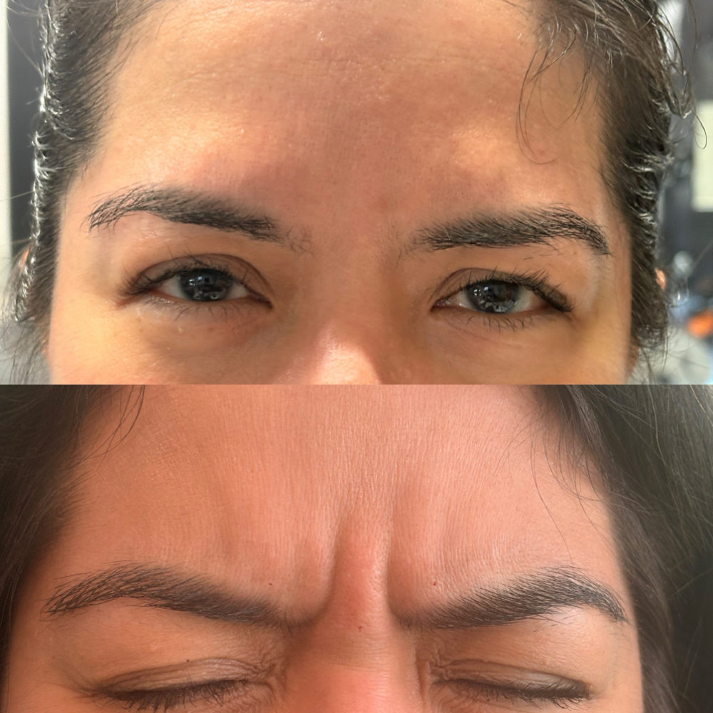 Glabella Botox (Frown Lines) at TRES Aesthetics in Missouri, TX