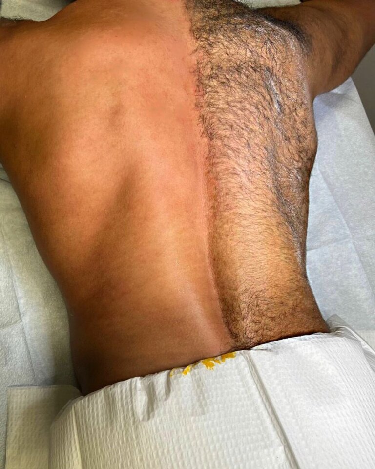 Back wax at Dew Drop Aesthetics LLC in Fort Smith, AR