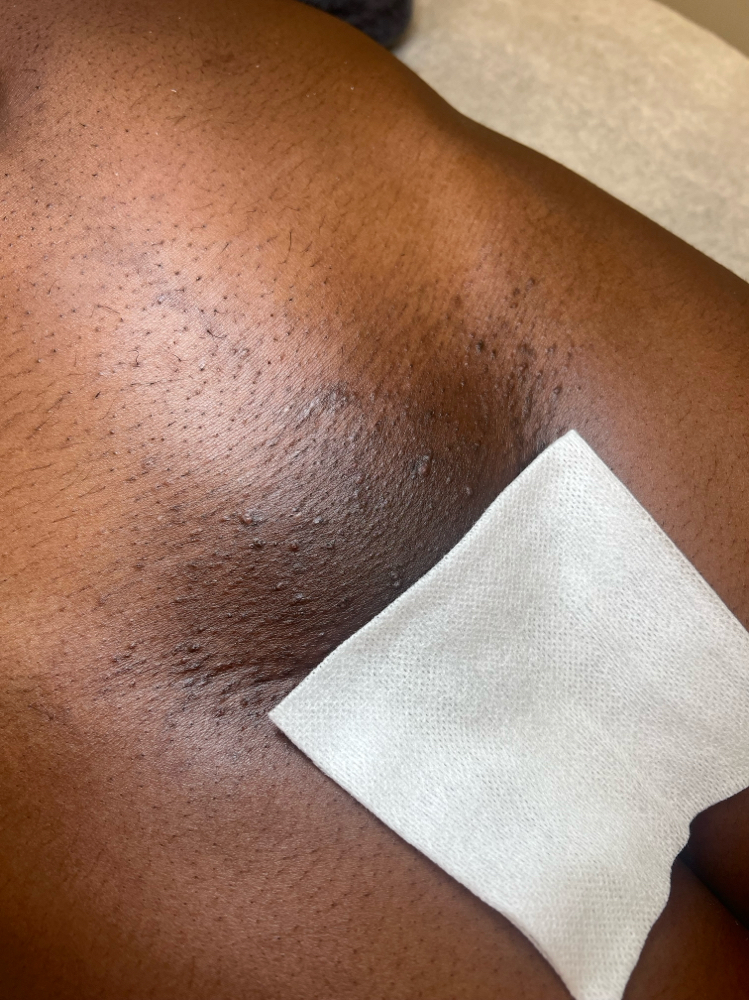 New Client Brazilian w/Underarm at Golden Vanity Aesthetics in Riverside, CA