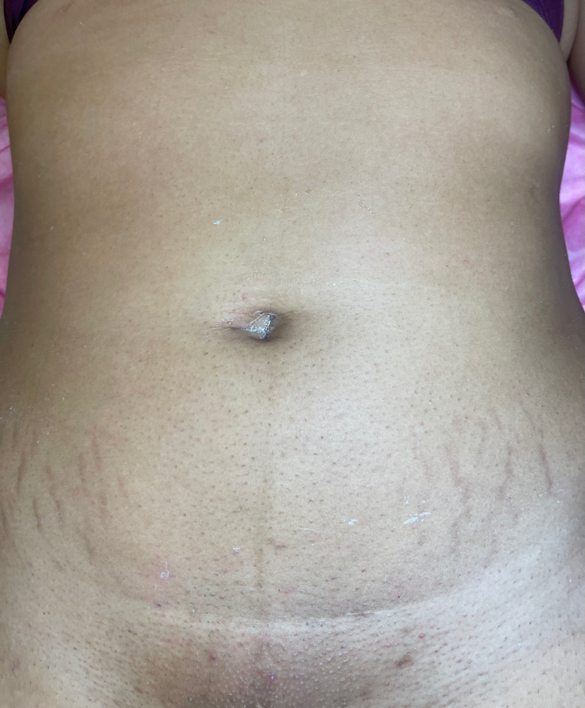 Stomach Wax