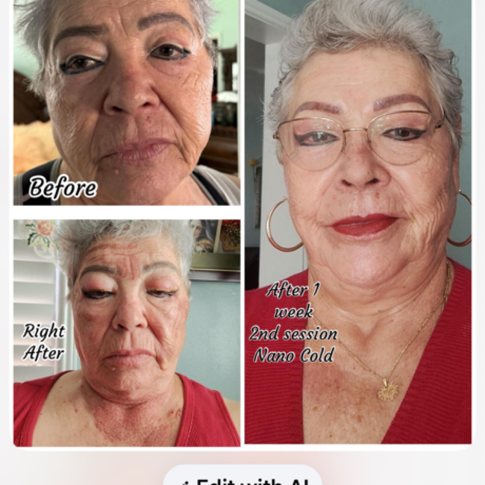 Nano Cold Full Face at Excellent Nails By Sandy in California, CA